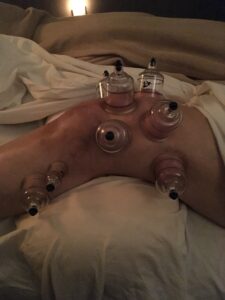 Demonstration of fiberglass cups used in cupping therapy on someone's knee